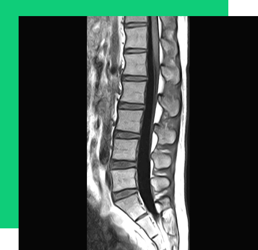 Lumbar Spine