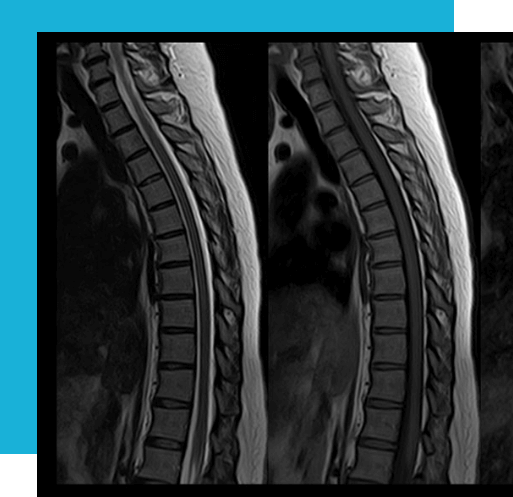 Thoracic Spine